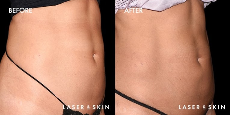 Body Contouring CoolTone Result #3