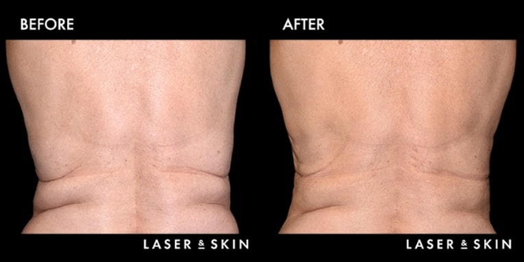 Body Contouring CoolSculpting Result #5