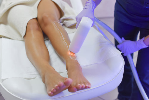 Laser Hair Removal Treatment Session