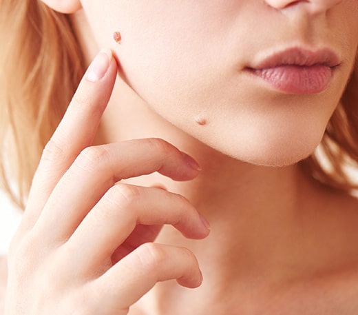 Cosmetic Mole Removal Treatment