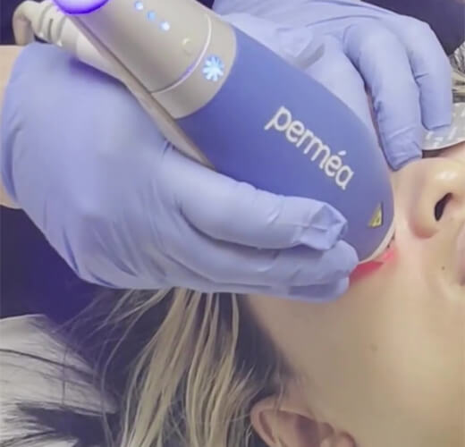 cb_permea_lasers_devices What is Clear + Brilliant Permea