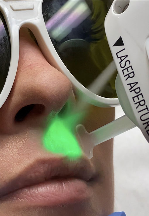 Clarity II Lasers & Devices Sacramento CA