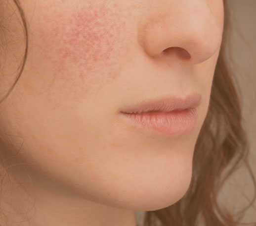 Acne Scars