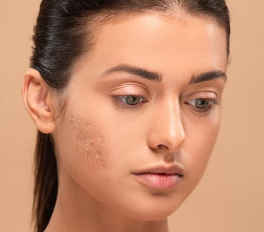 Acne Scars Laser Skin Surgery Center of Northern California
