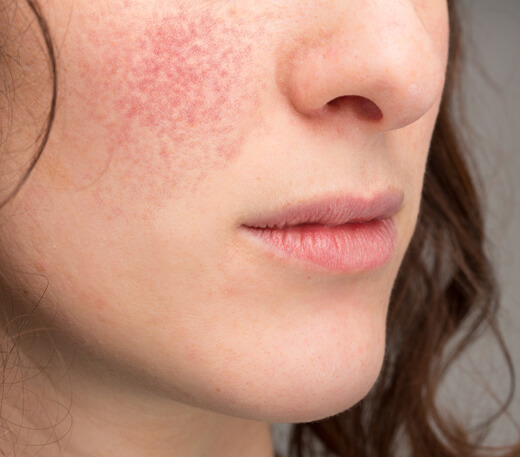 facial redness rosacea