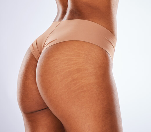 stretch marks