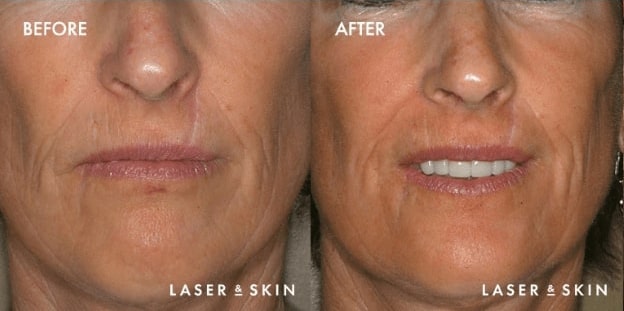 Frational-Ablative-Laser-result-1.jpg
