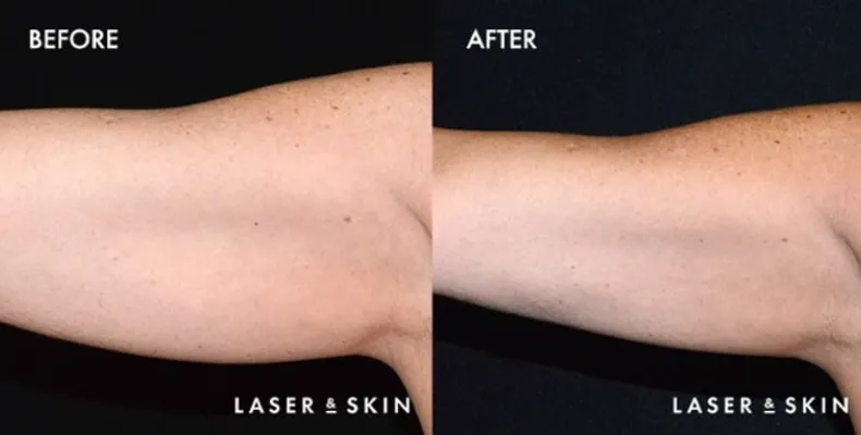 Treatments_BodyContouring-CoolSculpting3