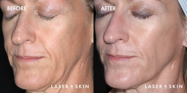 Treatments_LaserDevices-Ultherapy3.jpeg