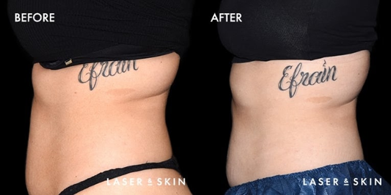 Body Contouring CoolTone Result #1