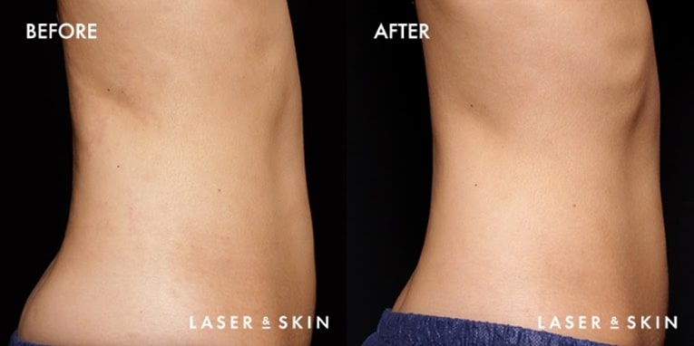 Body Contouring EmSculpt Result #1