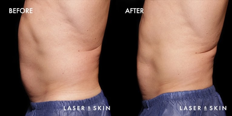 Body Contouring EmSculpt Result #2