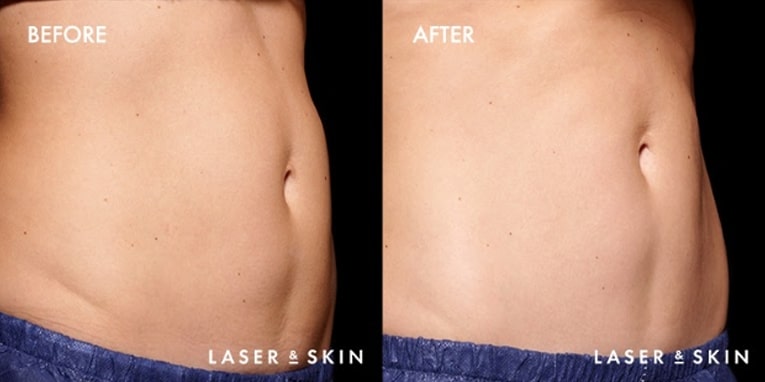 Body Contouring EmSculpt Result #3