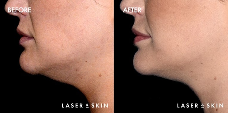 Body Contouring Kybella Result #1