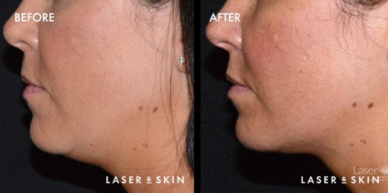 Body Contouring Kybella Result #2