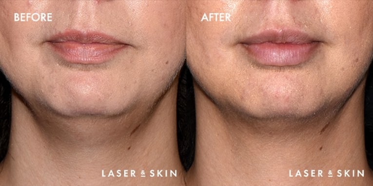 Body Contouring Kybella Result #3