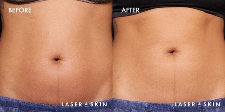 Body Contouring TruSculpt Result #1