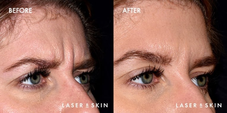 Injectables Botox Result #1