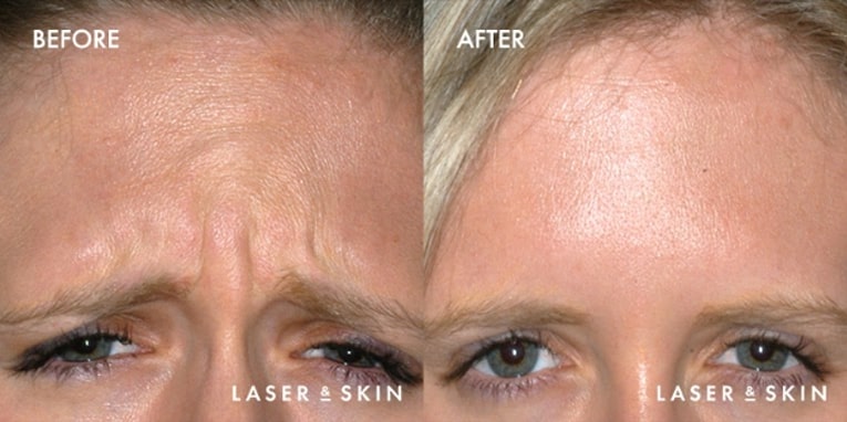 Injectables Botox Result #3