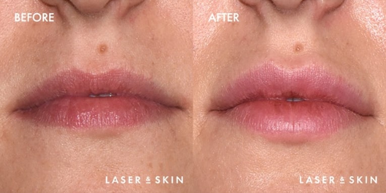 Pre Juvederm Volbella treatment & Post Juvederm Volbella Hyaluronic Acid Filler to lips