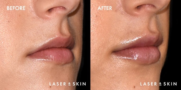 Pre Juvederm Volbella treatment & Post Juvederm Volbella Hyaluronic Acid Filler to lips