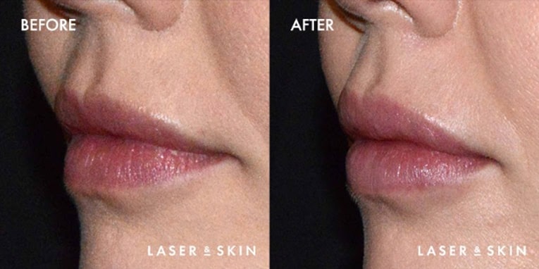 Pre Juvederm Volbella treatment