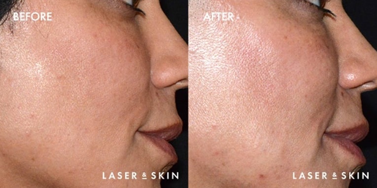 Pre Juvederm Voluma & Post Juvederm Voluma Hyaluronic Acid Filler to the cheeks