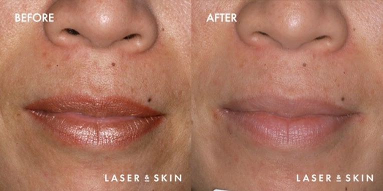 Pre Restylane treatment & Post Restylane Hyaluronic Acid Filler to nasolabial folds