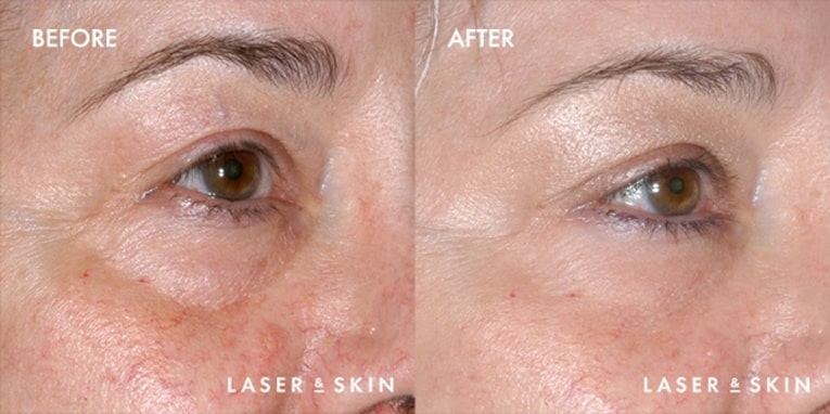 Pre Restylane treatment & Post Restylane Hyaluronic Acid Filler to under eye area