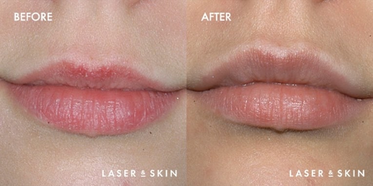 Pre Restylane treatment & Post Restylane Hyaluronic Acid Filler to lips