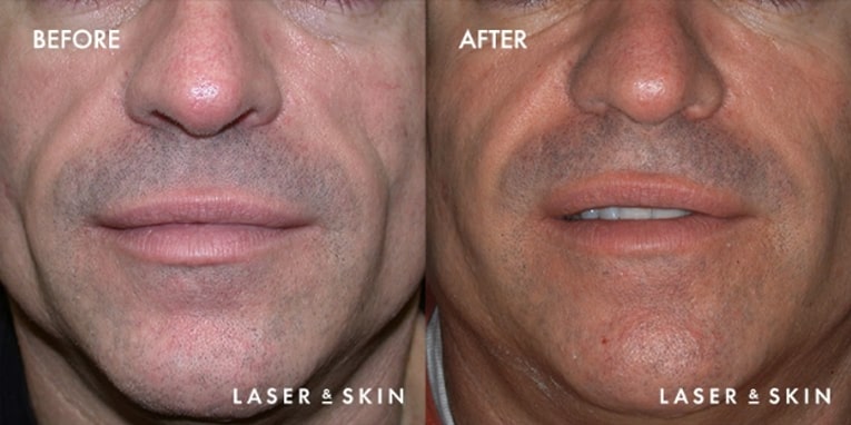 Sculptra Aesthetic Before & After Result 1