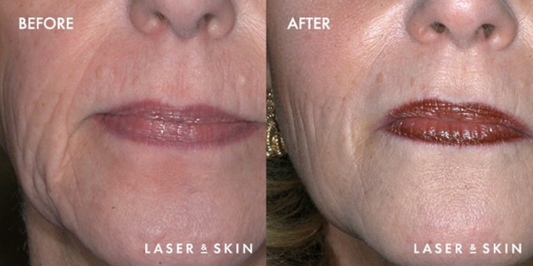 Sculptra Aesthetic Before & After Result 2