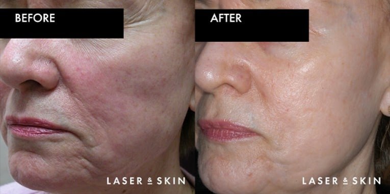 CO2 Laser Treatment - Laser skin resurfacing - Newfoundland, Canada