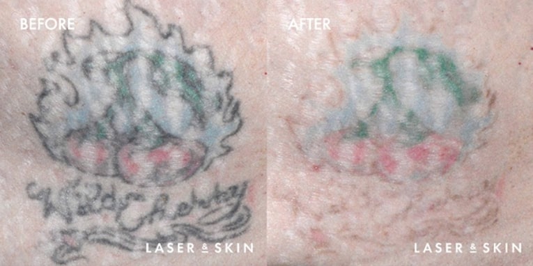 We can eliminate black, red, brown, green and blue inks for large or small  tattoos in sensitive areas. ⁠ ⁠ TECH⁠ Picosecond and Q-s... | Instagram