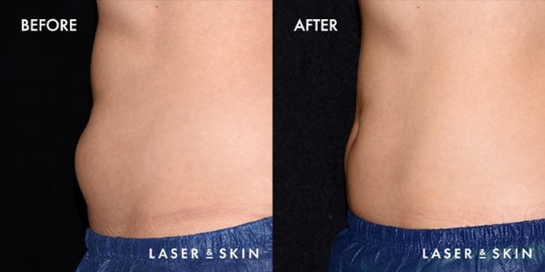 Body Contouring CoolSculpting Result #1