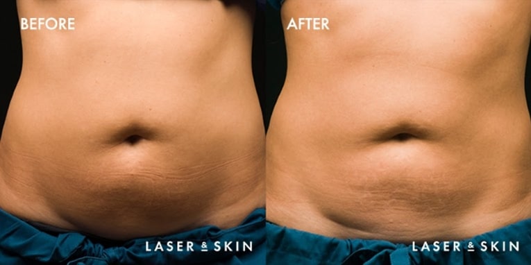 Body Contouring CoolSculpting Result #4