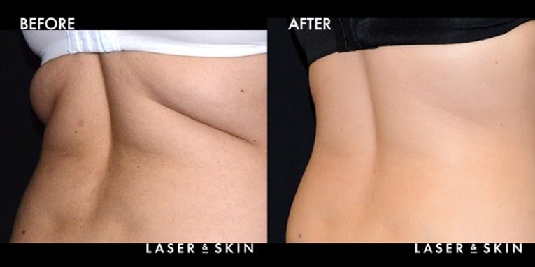 Body Contouring CoolSculpting Result #6