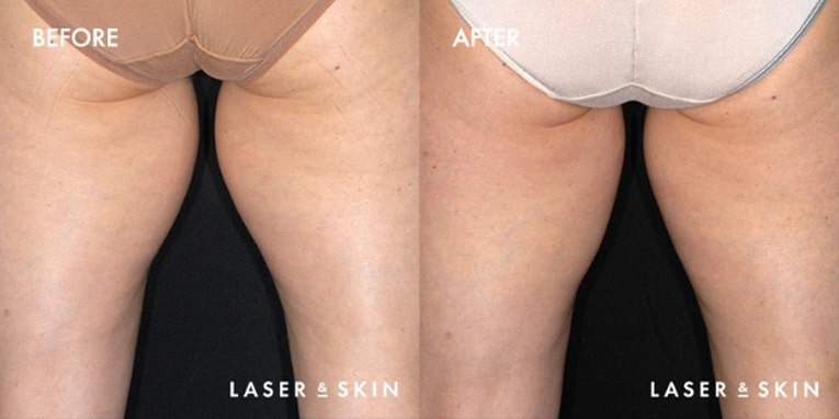 Body Contouring CoolSculpting Result #8
